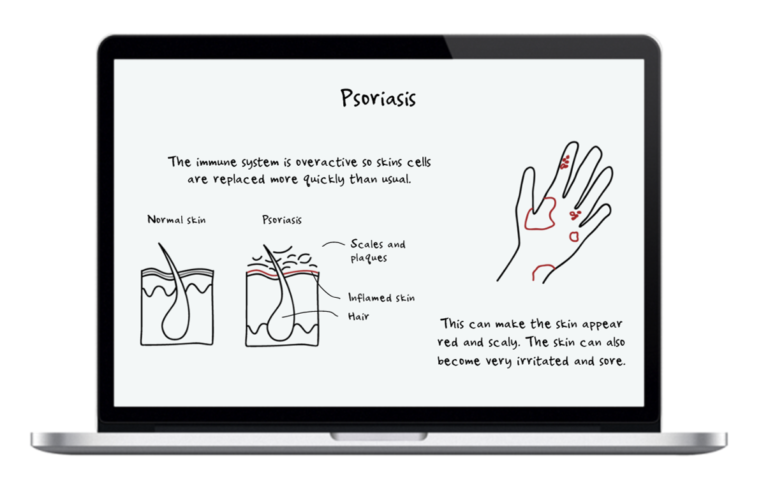 patient preference survey psoriasis_visual explanation of the disease